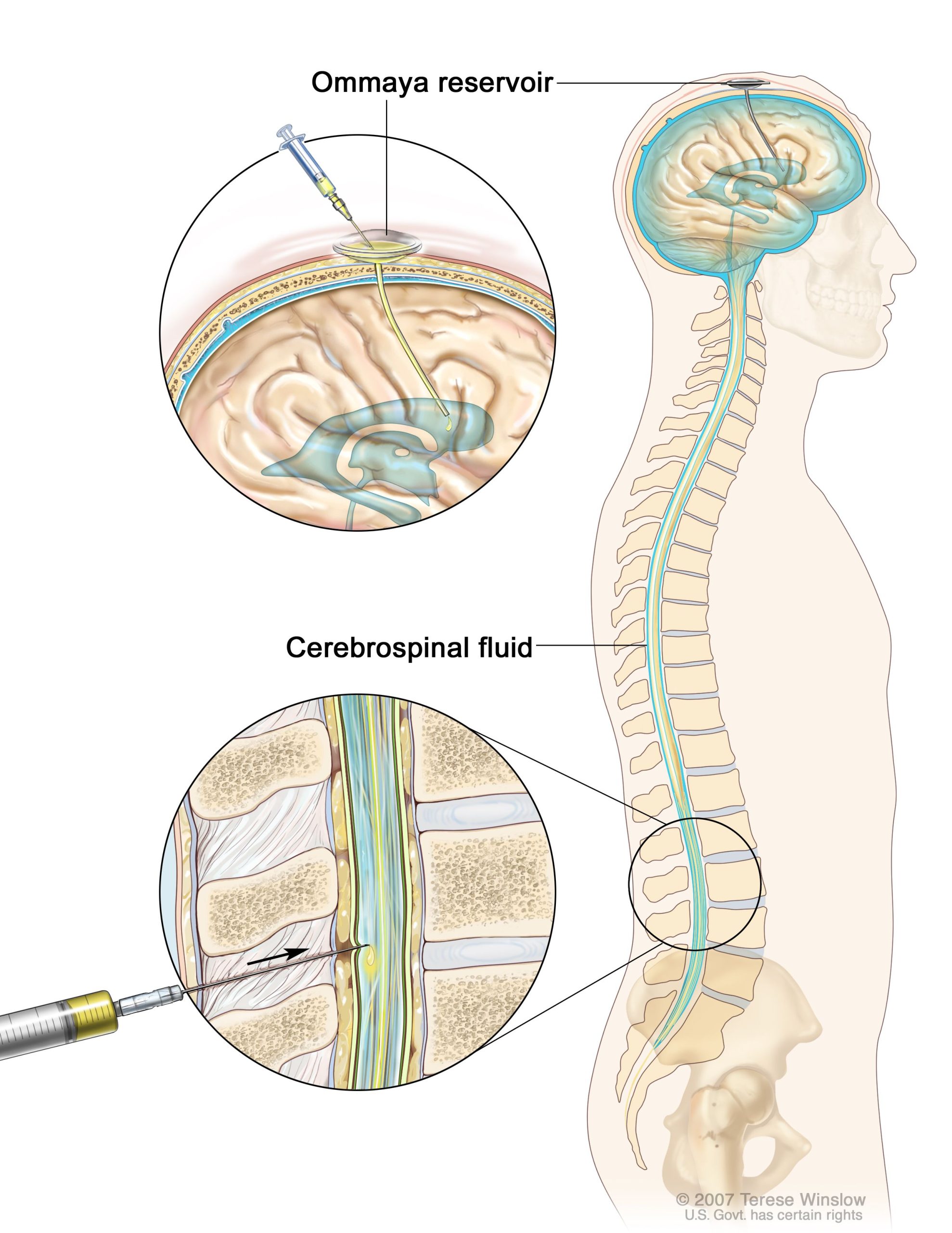 Intrathecal Chemotherapy Methods