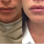 Lip Flip Before and After